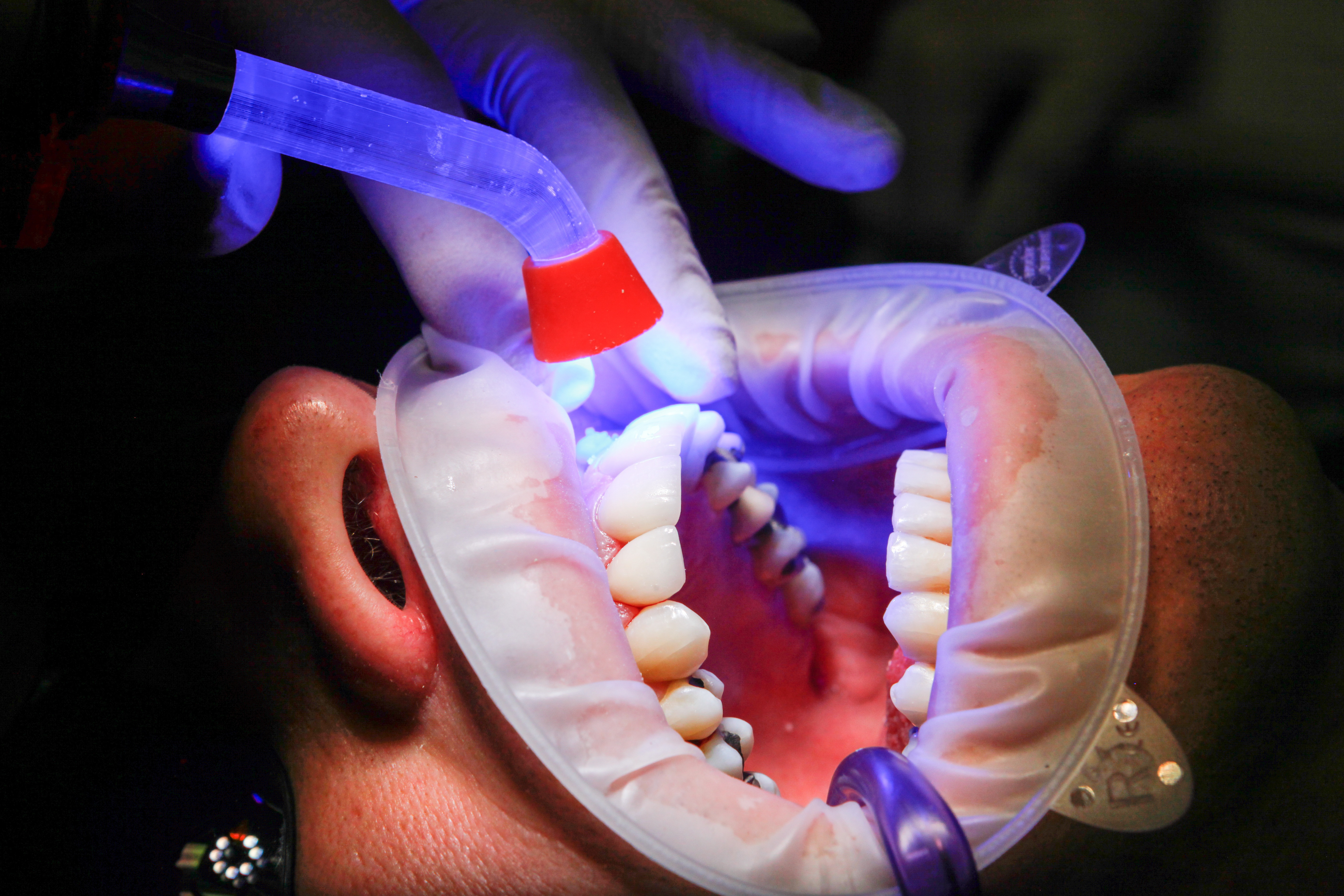 Dental procedure at Doctors Dental Care